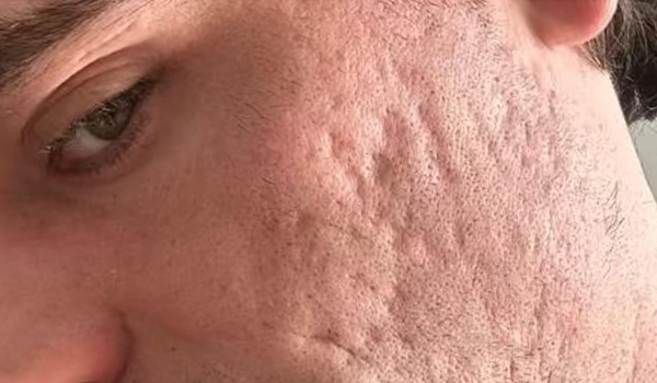 Lydia Esthetics Embassy Close-up of a person's cheek showing visible acne scars and uneven skin texture, ideal for treatments like microneedling with exosomes New York to help rejuvenate skin. New York
