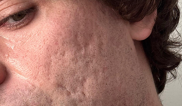 Lydia Esthetics Embassy Close-up of a person's cheek showing visible acne scars, facial hair stubble, and skin texture—ideal for microneedling with exosomes New York at Esthetics Embassy, your destination for advanced skin renewal. New York