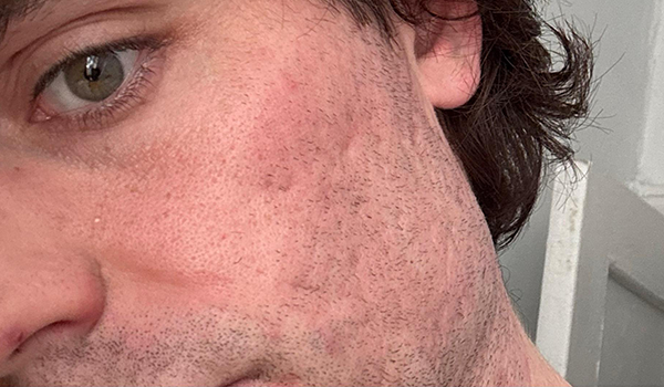 Lydia Esthetics Embassy Close-up of the left side of a person's face showing light facial hair, visible pores, and faint acne scars on the cheek—perfect for assessing results after microneedling with exosomes New York. New York