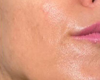 Lydia Esthetics Embassy Close-up of a person's lower face showing smooth, slightly shiny skin and part of the lips after a Biologique Recherche facial in New York. New York