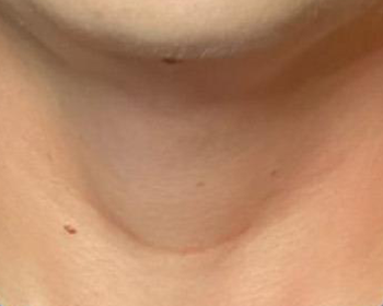 Lydia Esthetics Embassy Close-up image of a person's neck with a horizontal scar at the base, below the chin and above the collarbone—showcasing results after microneedling with exosomes New York at Esthetics Embassy. New York