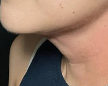 Lydia Esthetics Embassy Close-up of a person's lower face, jawline, and neck, wearing a dark top with a white strap visible on the shoulder; skin has small moles and is slightly flushed—ideal results after microneedling with exosomes New York at Esthetics Embassy. New York
