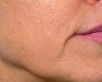Lydia Esthetics Embassy Close-up of the lower half of a person's face, showing the cheek, jawline, and part of the lips with visible skin texture and fine lines—ideal for showcasing results from microneedling with exosomes New York at Esthetics Embassy. New York