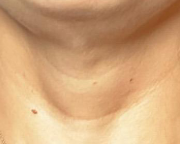 Lydia Esthetics Embassy Close-up of a person's neck and lower chin area, showing natural skin texture and a small mole on the left side—ideal for showcasing results from microneedling with exosomes New York at Esthetics Embassy New York. New York
