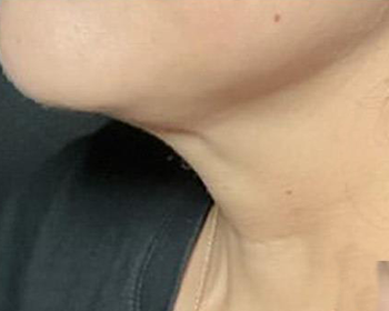 Lydia Esthetics Embassy Close-up of the lower face, chin, and neck of a person wearing a black shirt and a thin necklace at a luxury facial spa NYC. New York