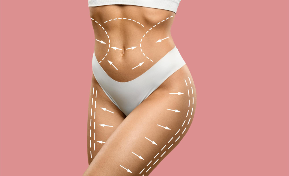 Lydia Esthetics Embassy A woman's torso and upper thighs with dashed white lines and arrows indicating contour areas on her body, against a pink background. New York